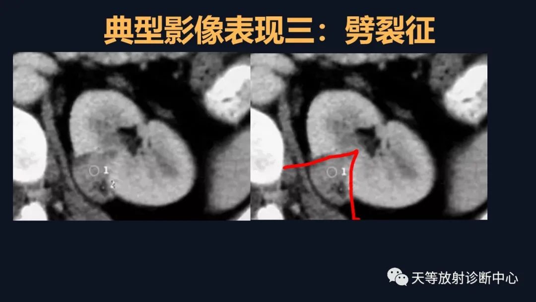 影像PPT - 【病例】肾血管平滑肌脂肪瘤1例CT影像-27 影像PPT - 【病例】肾血管平滑肌脂肪瘤1例CT影像-27
