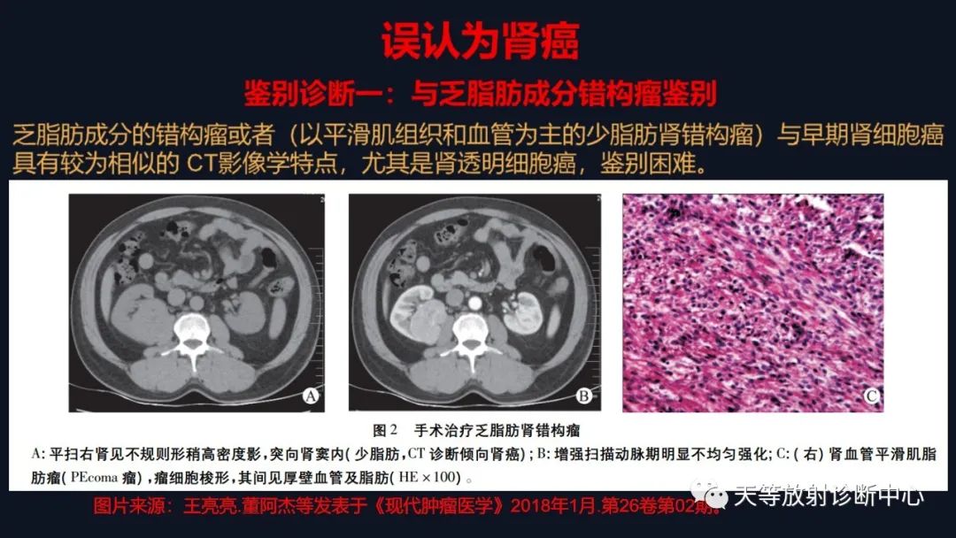 影像PPT - 【病例】肾血管平滑肌脂肪瘤1例CT影像-28 影像PPT - 【病例】肾血管平滑肌脂肪瘤1例CT影像-28