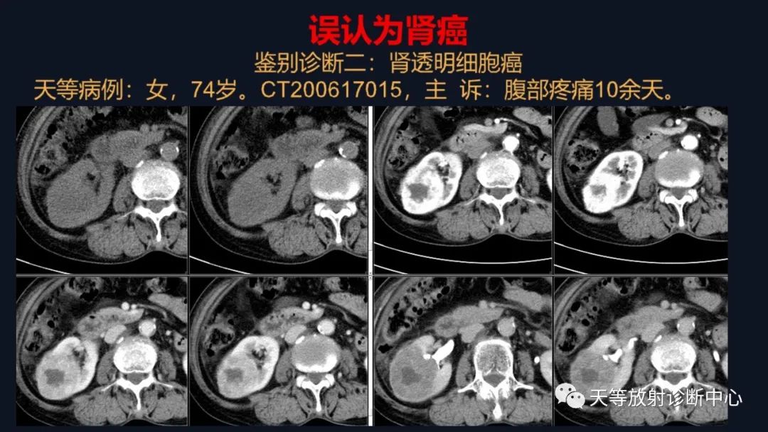 影像PPT - 【病例】肾血管平滑肌脂肪瘤1例CT影像-29 影像PPT - 【病例】肾血管平滑肌脂肪瘤1例CT影像-29