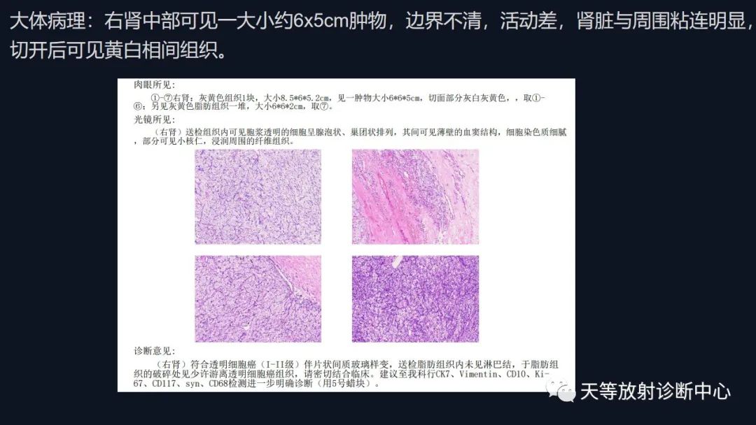 影像PPT - 【病例】肾血管平滑肌脂肪瘤1例CT影像-30 影像PPT - 【病例】肾血管平滑肌脂肪瘤1例CT影像-30