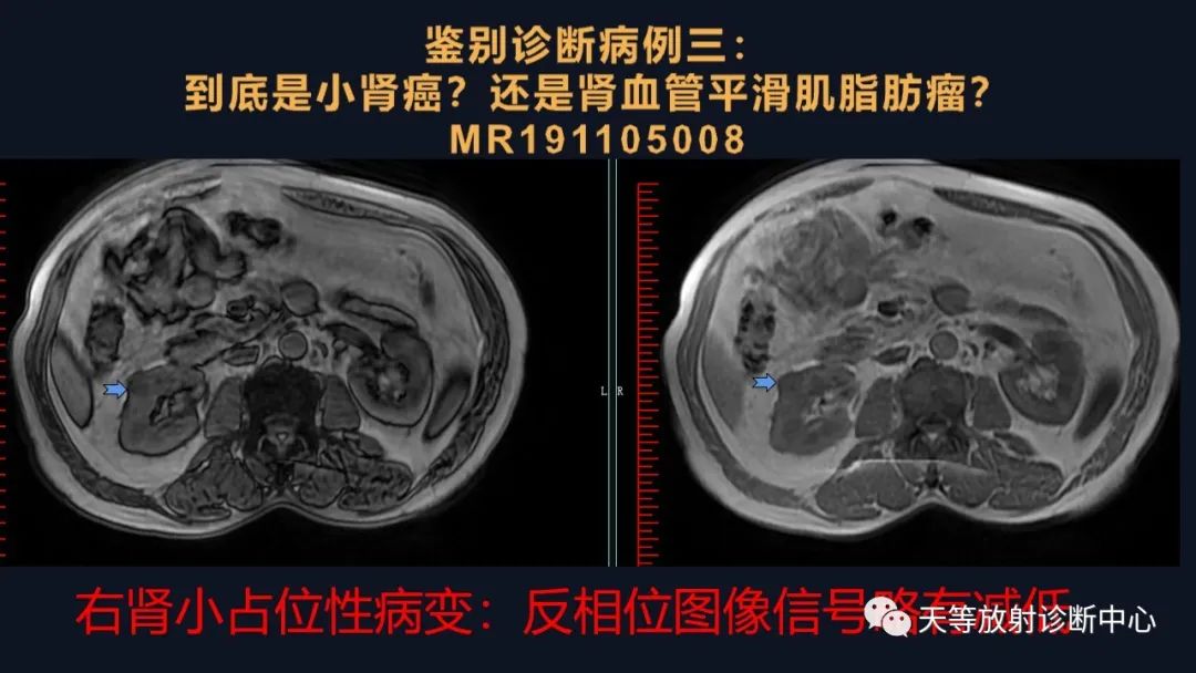 影像PPT - 【病例】肾血管平滑肌脂肪瘤1例CT影像-31 影像PPT - 【病例】肾血管平滑肌脂肪瘤1例CT影像-31