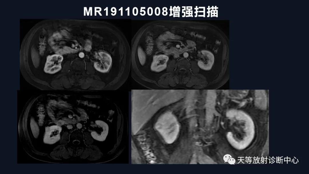 影像PPT - 【病例】肾血管平滑肌脂肪瘤1例CT影像-33 影像PPT - 【病例】肾血管平滑肌脂肪瘤1例CT影像-33