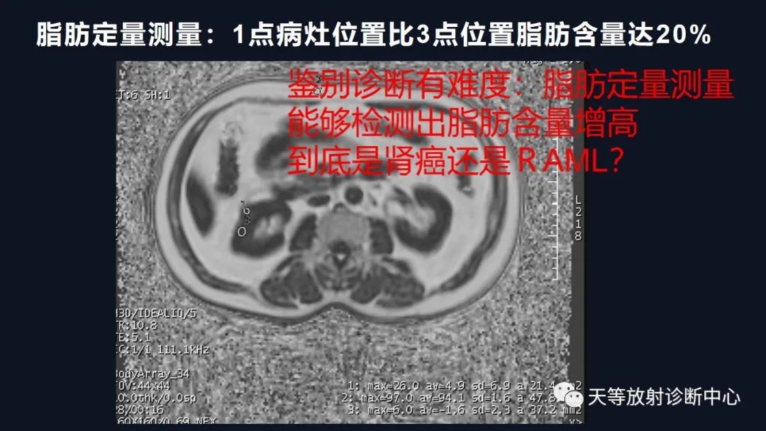 影像PPT - 【病例】肾血管平滑肌脂肪瘤1例CT影像-34 影像PPT - 【病例】肾血管平滑肌脂肪瘤1例CT影像-34