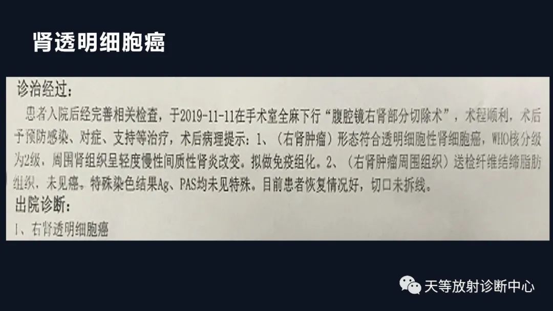影像PPT - 【病例】肾血管平滑肌脂肪瘤1例CT影像-36 影像PPT - 【病例】肾血管平滑肌脂肪瘤1例CT影像-36