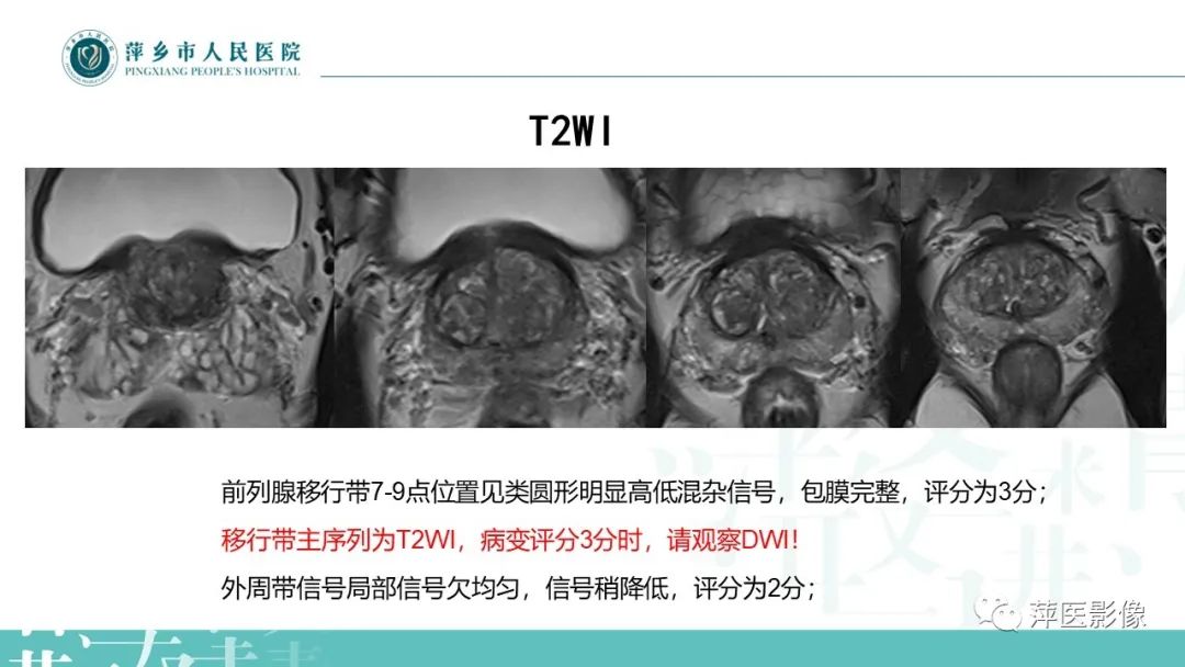 影像PPT - 【PPT】前列腺PI-RADS评分含解读-3