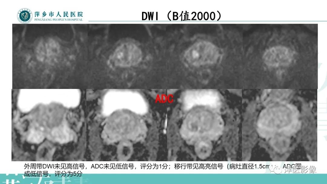 影像PPT - 【PPT】前列腺PI-RADS评分含解读-4