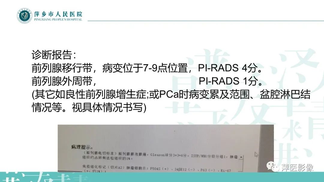 影像PPT - 【PPT】前列腺PI-RADS评分含解读-6