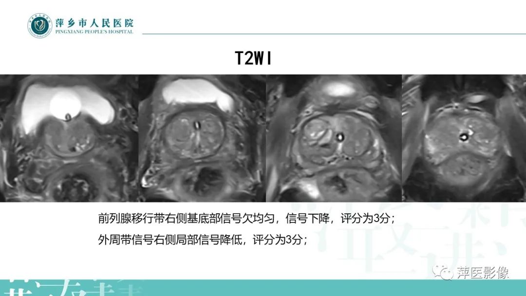 影像PPT - 【PPT】前列腺PI-RADS评分含解读-8