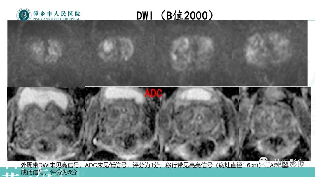 影像PPT - 【PPT】前列腺PI-RADS评分含解读-9