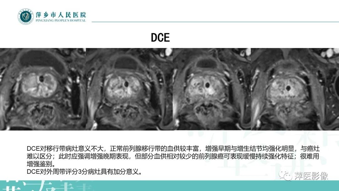 影像PPT - 【PPT】前列腺PI-RADS评分含解读-10