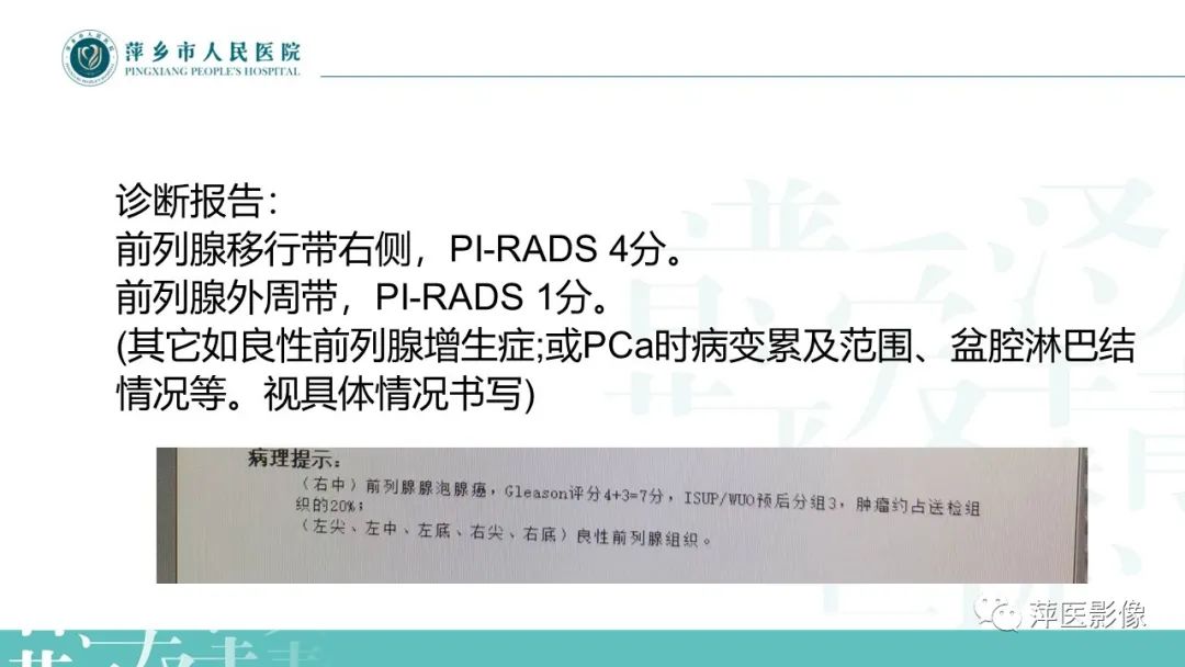 影像PPT - 【PPT】前列腺PI-RADS评分含解读-11