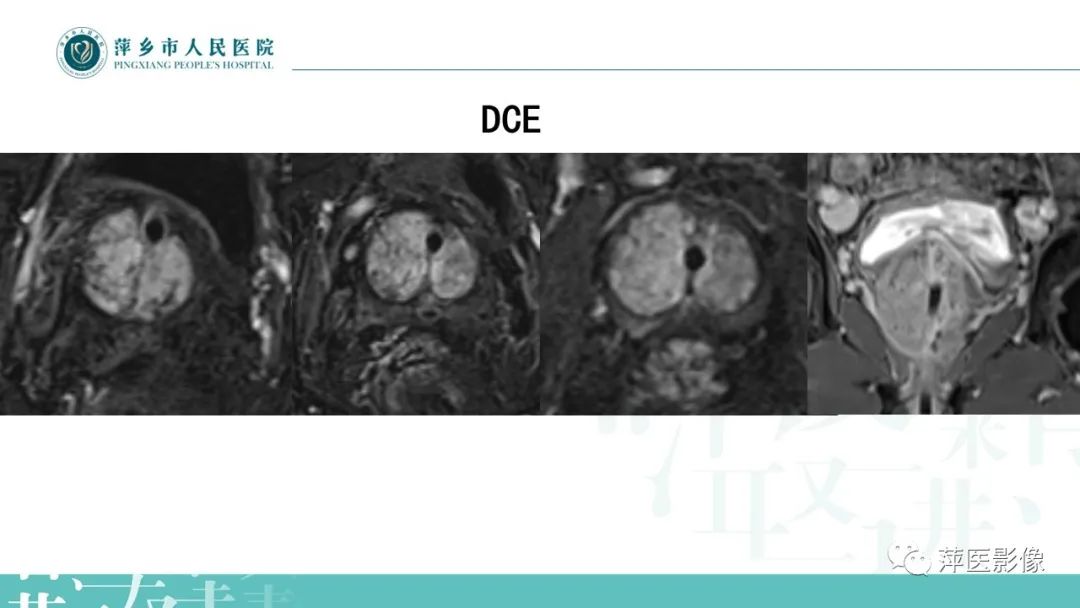 影像PPT - 【PPT】前列腺PI-RADS评分含解读-15