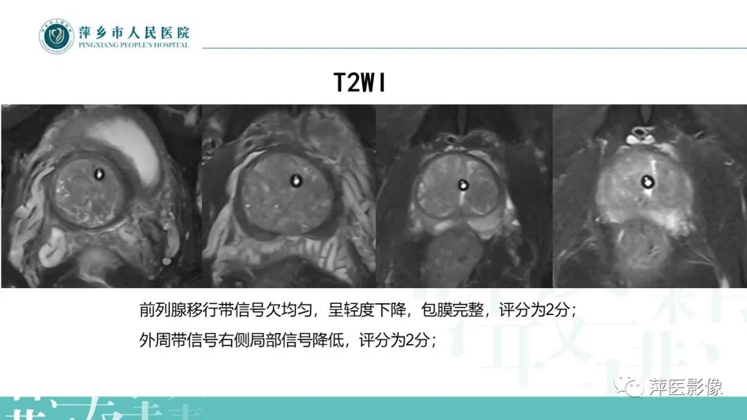 影像PPT - 【PPT】前列腺PI-RADS评分含解读-13