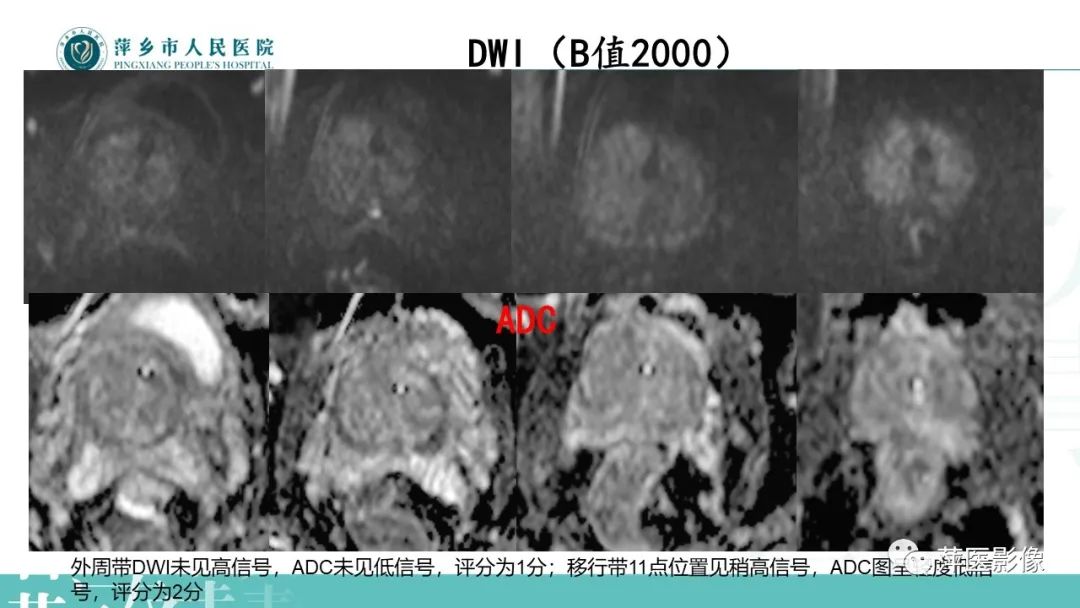 影像PPT - 【PPT】前列腺PI-RADS评分含解读-14
