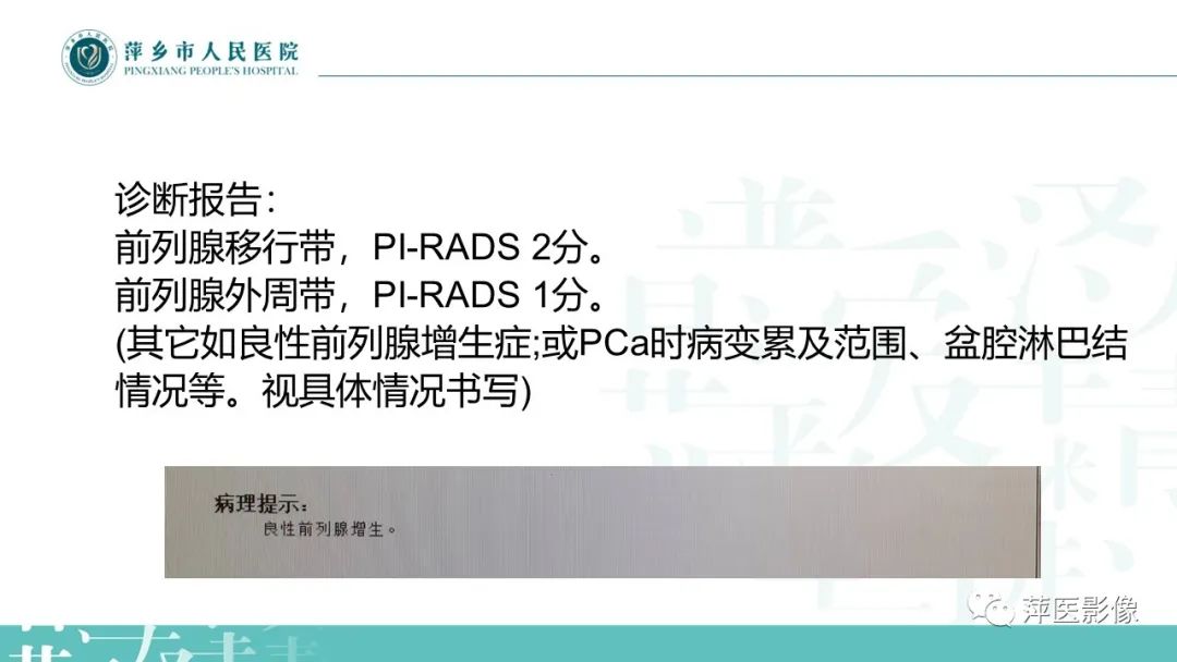 影像PPT - 【PPT】前列腺PI-RADS评分含解读-16