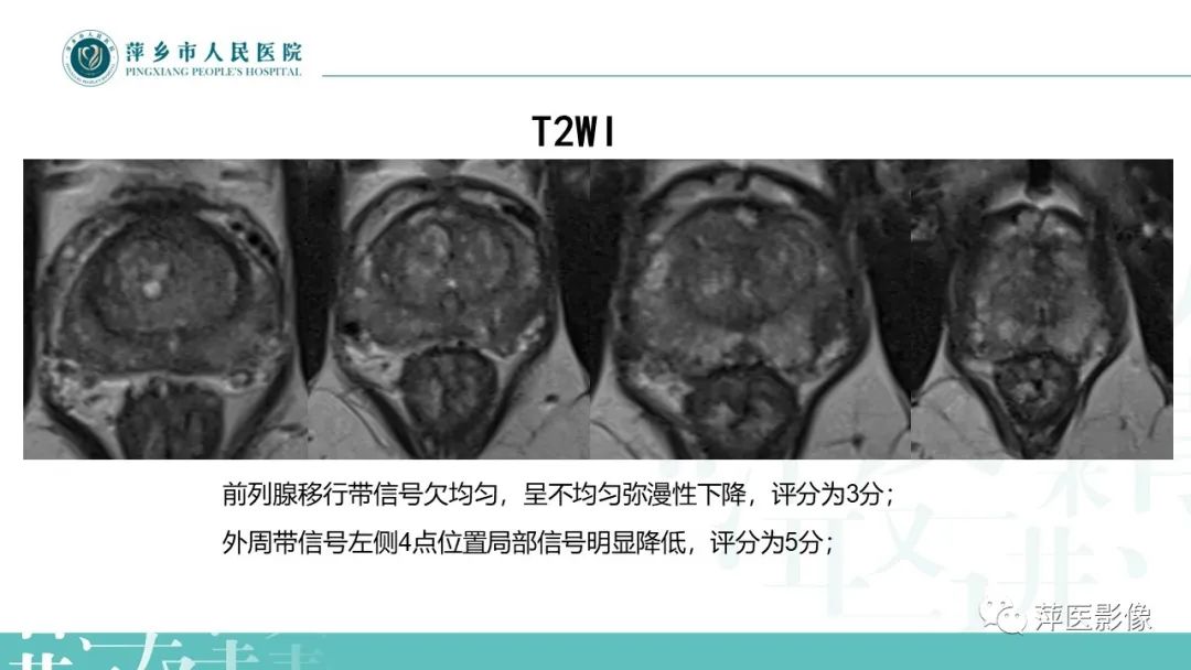 影像PPT - 【PPT】前列腺PI-RADS评分含解读-18