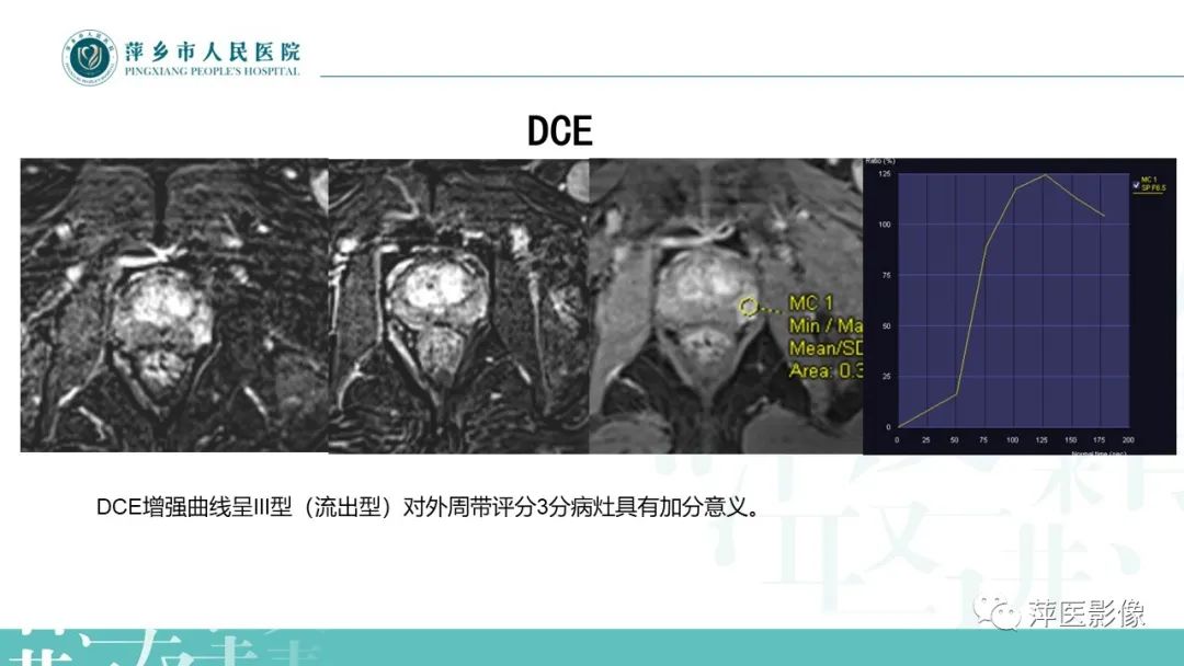 影像PPT - 【PPT】前列腺PI-RADS评分含解读-20