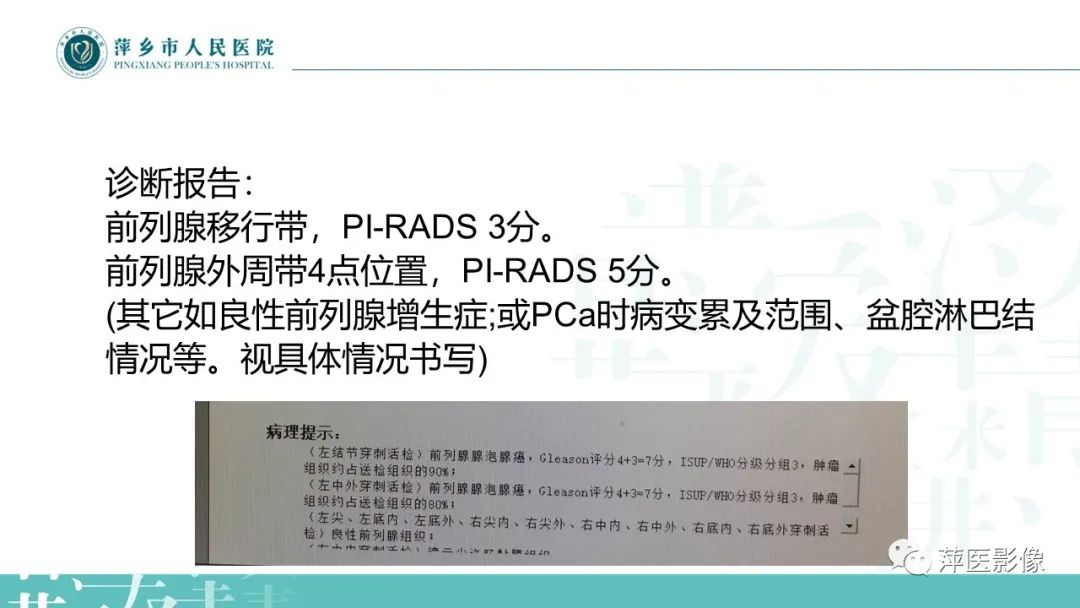 影像PPT - 【PPT】前列腺PI-RADS评分含解读-21