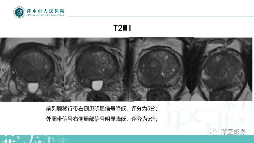 影像PPT - 【PPT】前列腺PI-RADS评分含解读-23