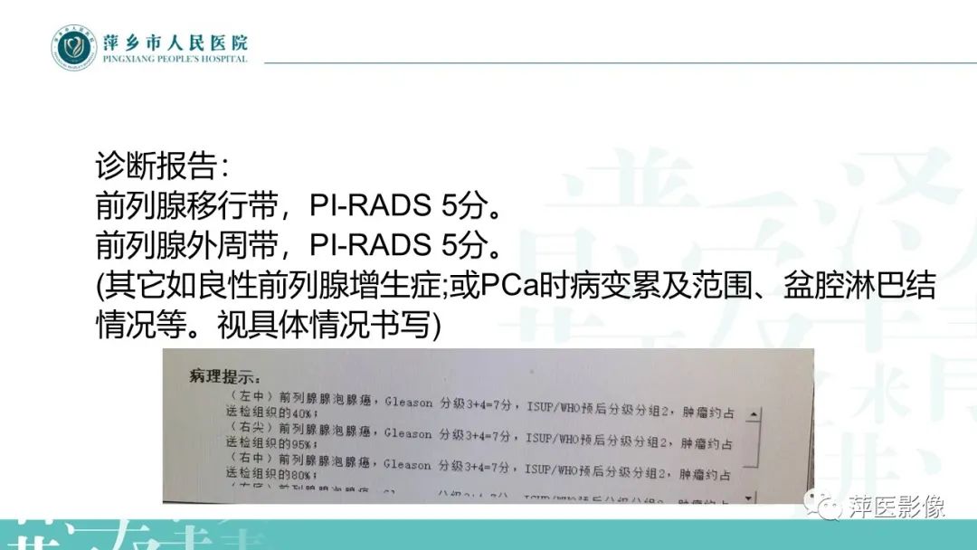 影像PPT - 【PPT】前列腺PI-RADS评分含解读-25