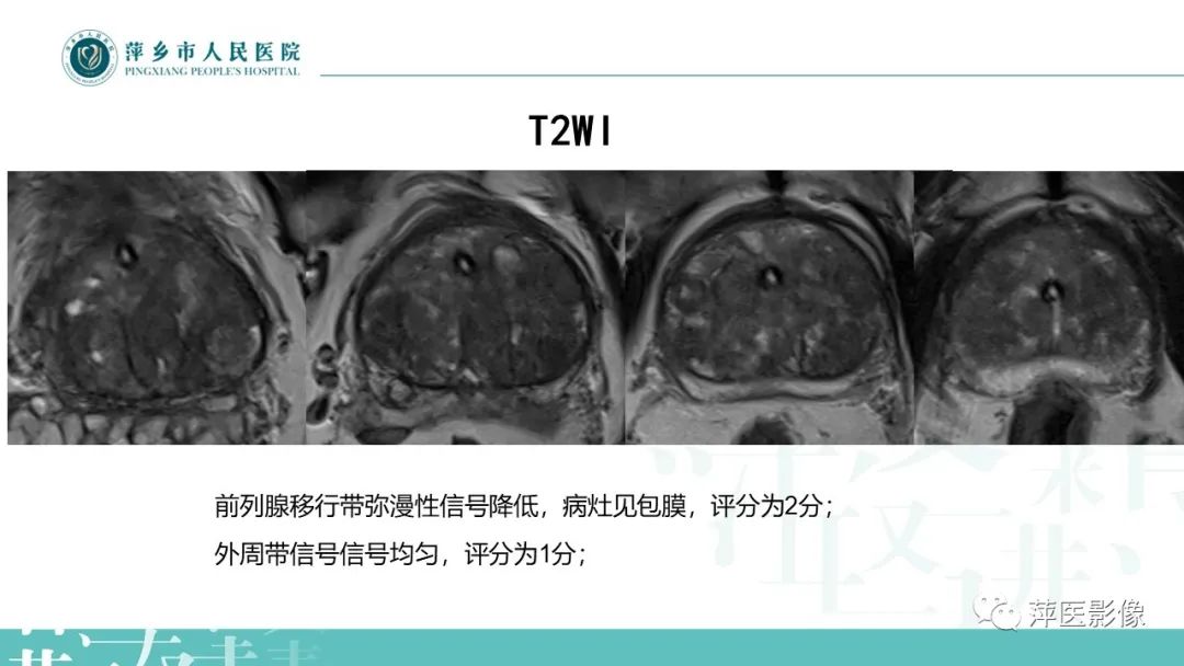 影像PPT - 【PPT】前列腺PI-RADS评分含解读-27