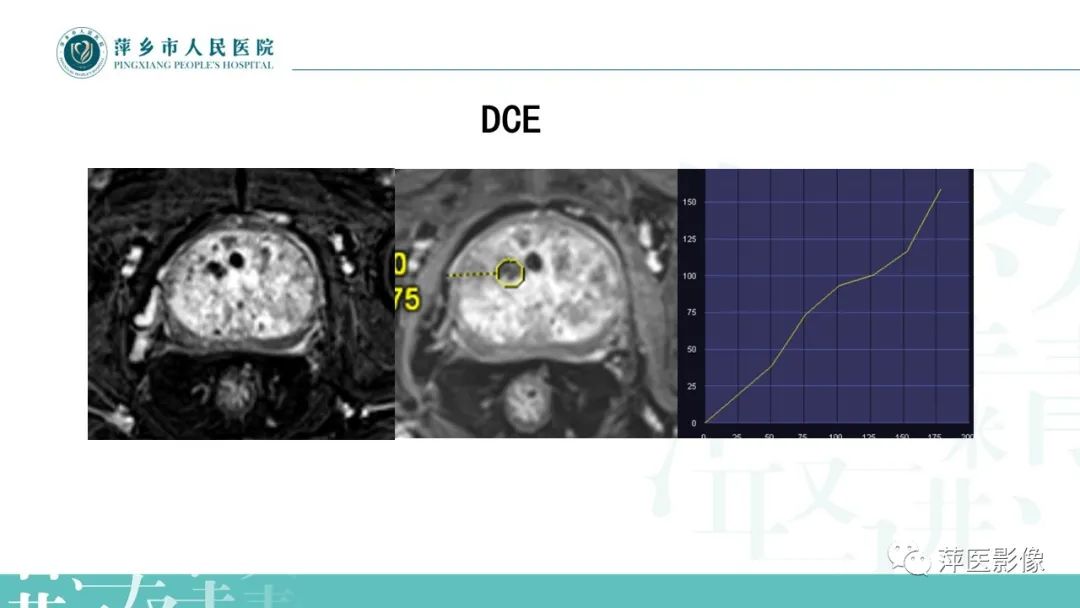 影像PPT - 【PPT】前列腺PI-RADS评分含解读-29