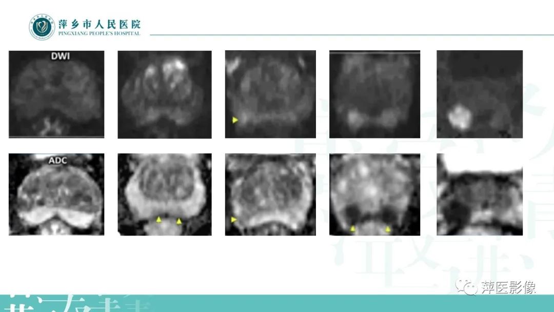 影像PPT - 【PPT】前列腺PI-RADS评分含解读-33