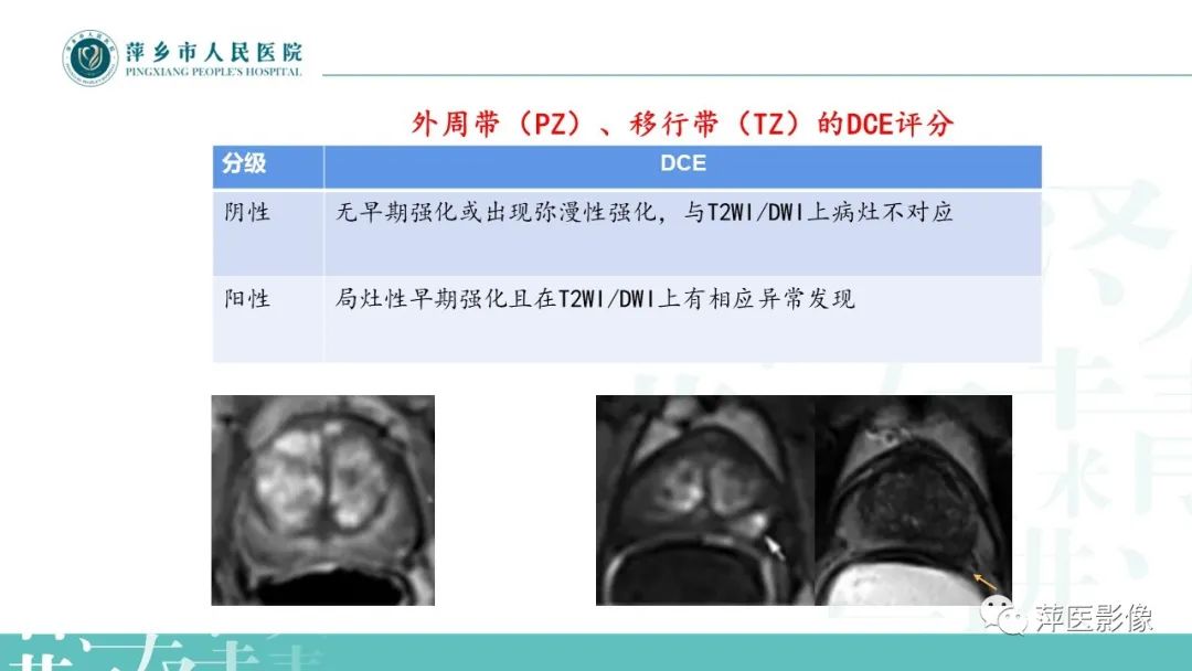 影像PPT - 【PPT】前列腺PI-RADS评分含解读-34