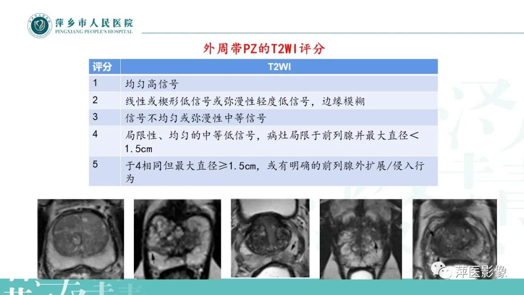 影像PPT - 【PPT】前列腺PI-RADS评分含解读-35