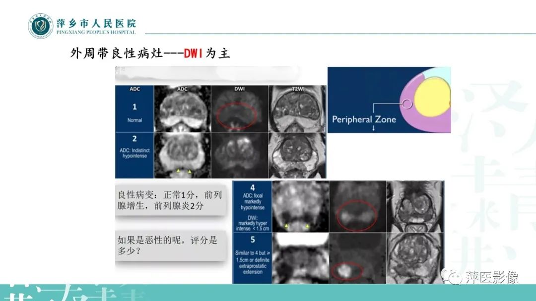 影像PPT - 【PPT】前列腺PI-RADS评分含解读-37