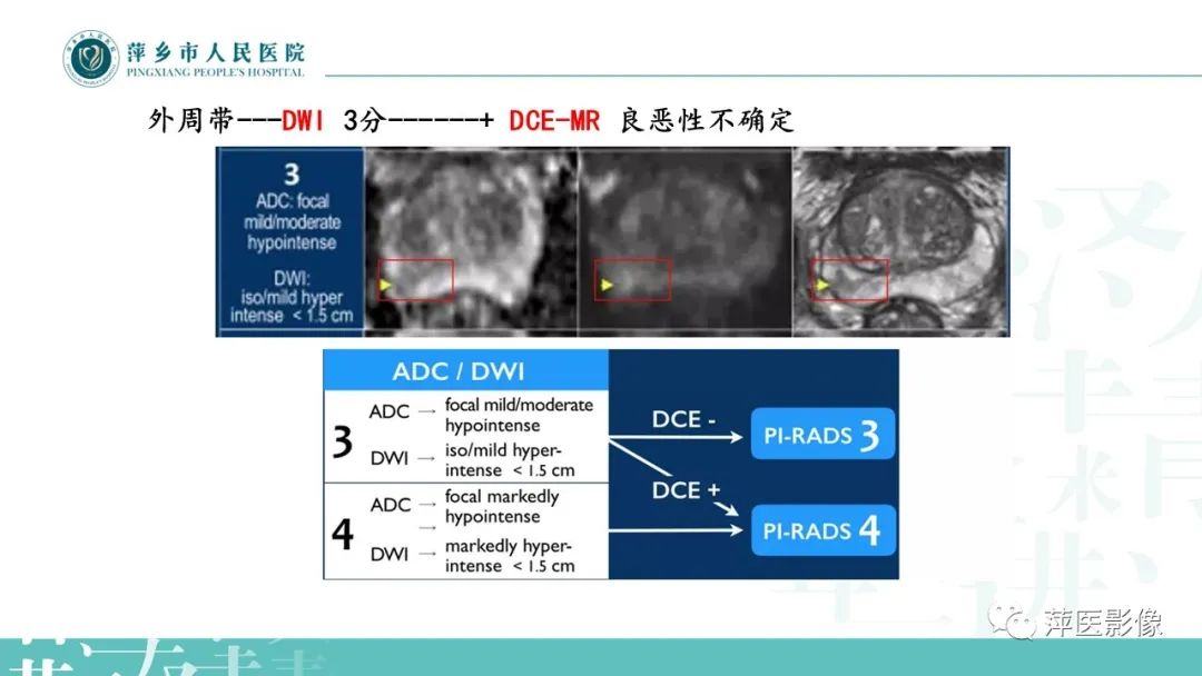 影像PPT - 【PPT】前列腺PI-RADS评分含解读-38