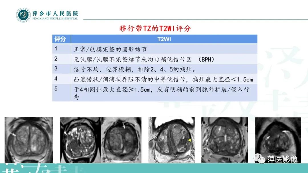 影像PPT - 【PPT】前列腺PI-RADS评分含解读-39