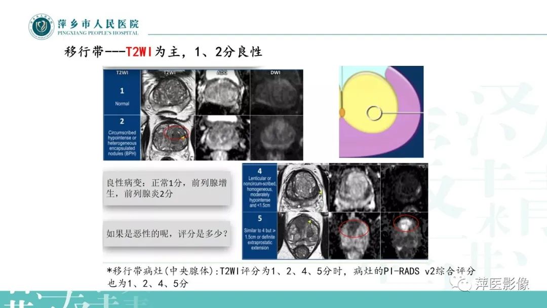 影像PPT - 【PPT】前列腺PI-RADS评分含解读-42