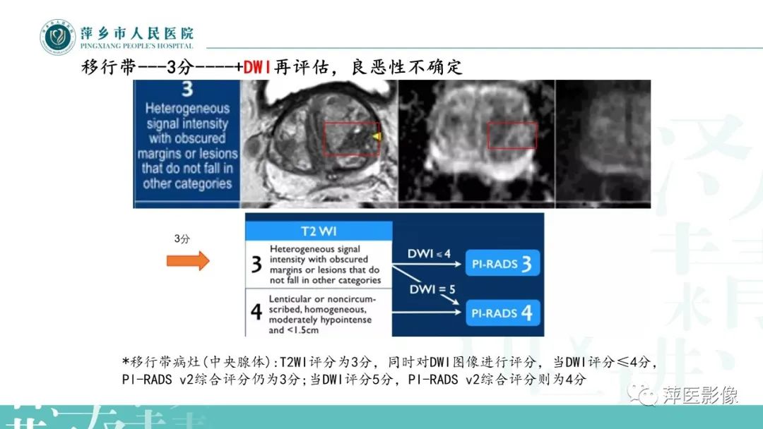 影像PPT - 【PPT】前列腺PI-RADS评分含解读-43