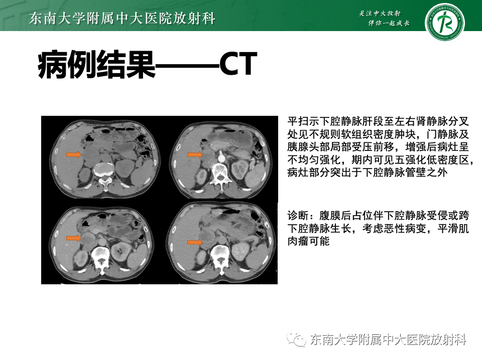 影像PPT - 【PPT】腹膜后平滑肌肉瘤-4