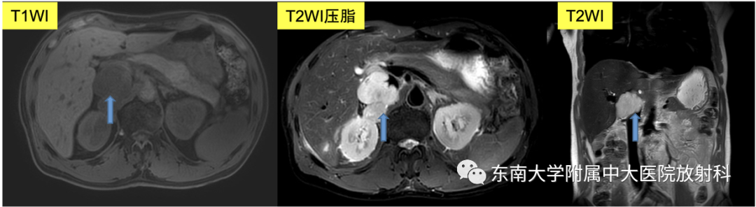 影像PPT - 【PPT】腹膜后平滑肌肉瘤-2