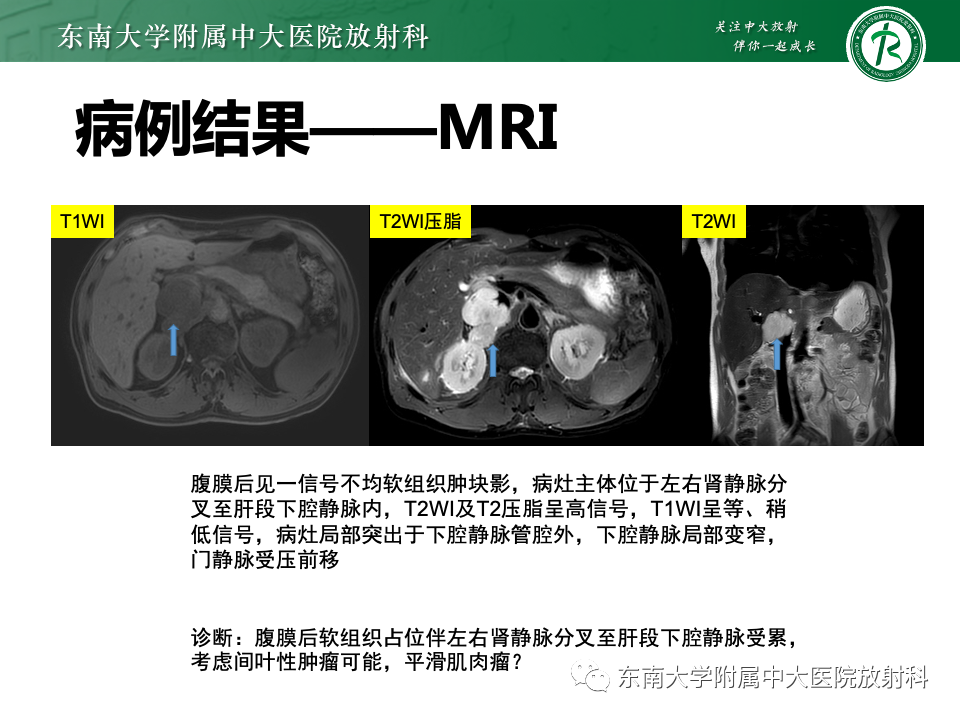 影像PPT - 【PPT】腹膜后平滑肌肉瘤-5