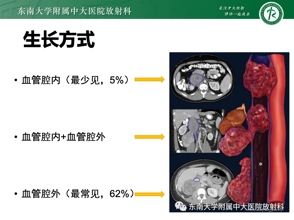 影像PPT - 【PPT】腹膜后平滑肌肉瘤-12