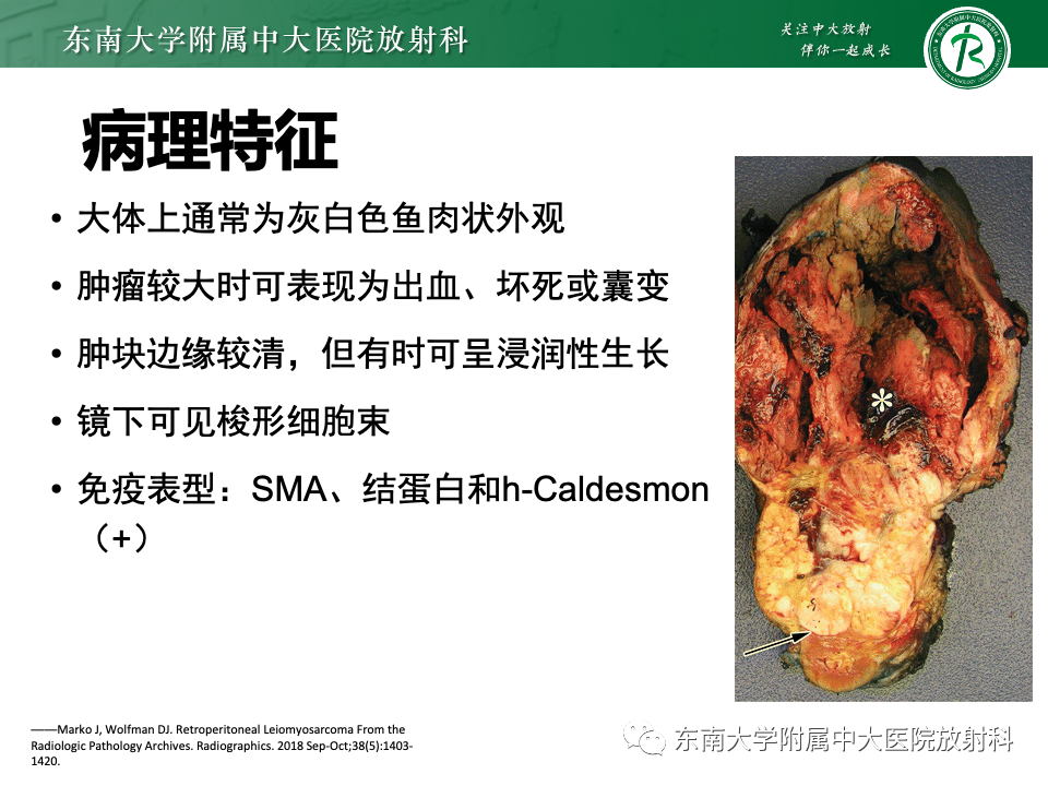 影像PPT - 【PPT】腹膜后平滑肌肉瘤-14