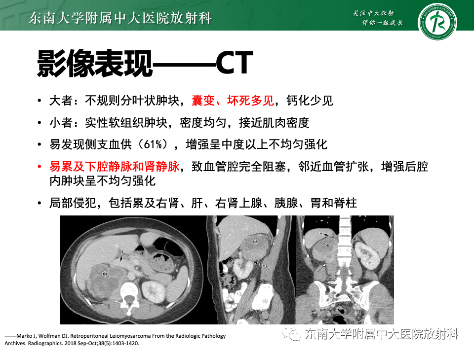 影像PPT - 【PPT】腹膜后平滑肌肉瘤-16