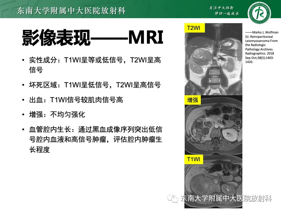 影像PPT - 【PPT】腹膜后平滑肌肉瘤-17