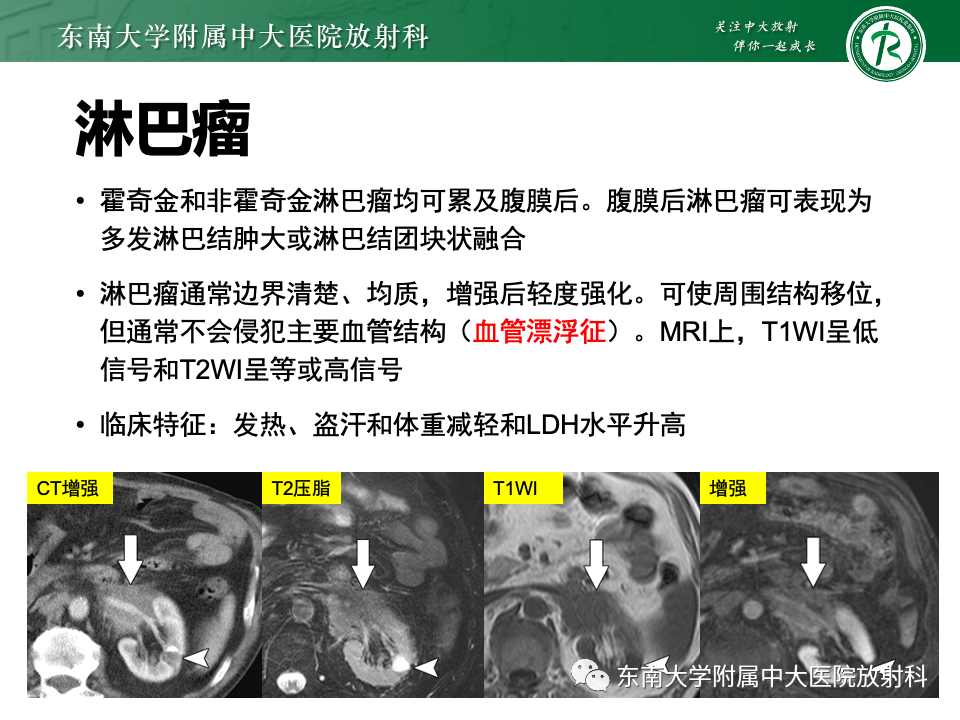 影像PPT - 【PPT】腹膜后平滑肌肉瘤-19