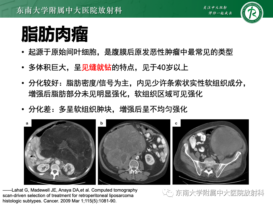 影像PPT - 【PPT】腹膜后平滑肌肉瘤-20