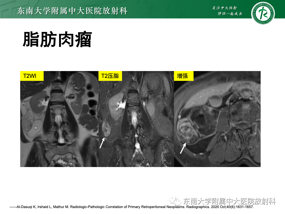影像PPT - 【PPT】腹膜后平滑肌肉瘤-21