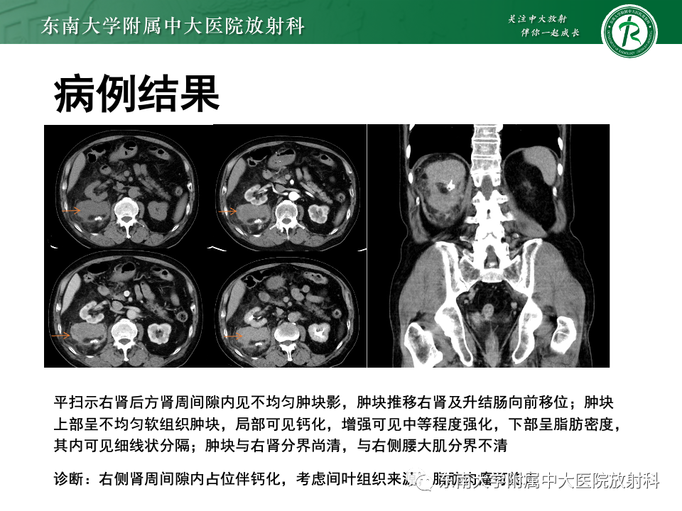 影像PPT - 【PPT】腹膜后平滑肌肉瘤-23