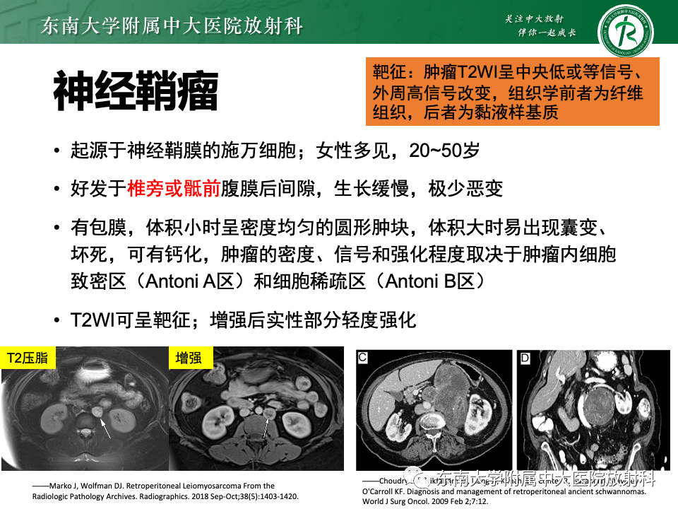 影像PPT - 【PPT】腹膜后平滑肌肉瘤-24