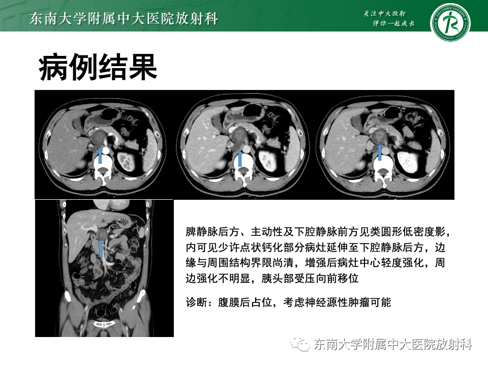 影像PPT - 【PPT】腹膜后平滑肌肉瘤-26