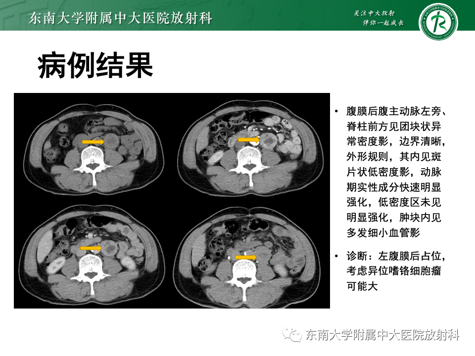 影像PPT - 【PPT】腹膜后平滑肌肉瘤-29