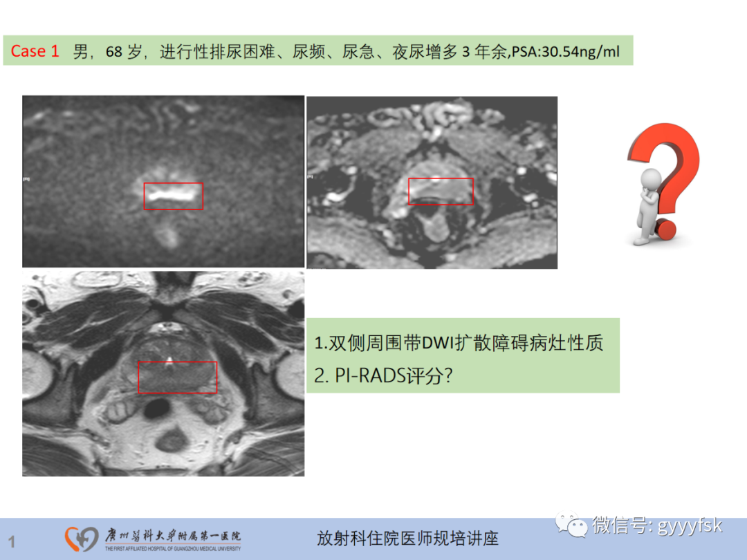 影像PPT - 【PPT】前列腺癌的MR扫描规范及精准诊断-2