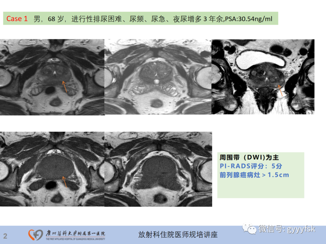 影像PPT - 【PPT】前列腺癌的MR扫描规范及精准诊断-3